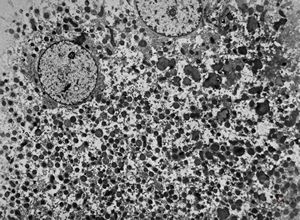F,3m. | giant cell hepatitis